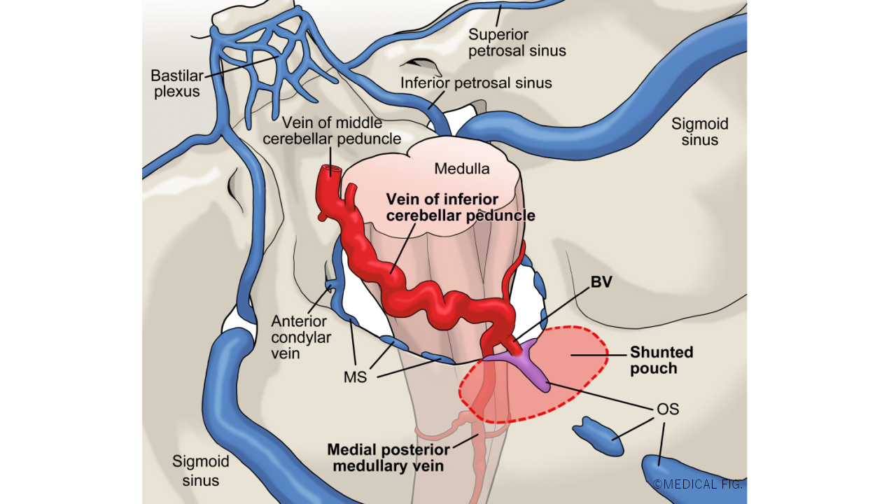 Acta Neurochirurgica」掲載研究論文用Figure